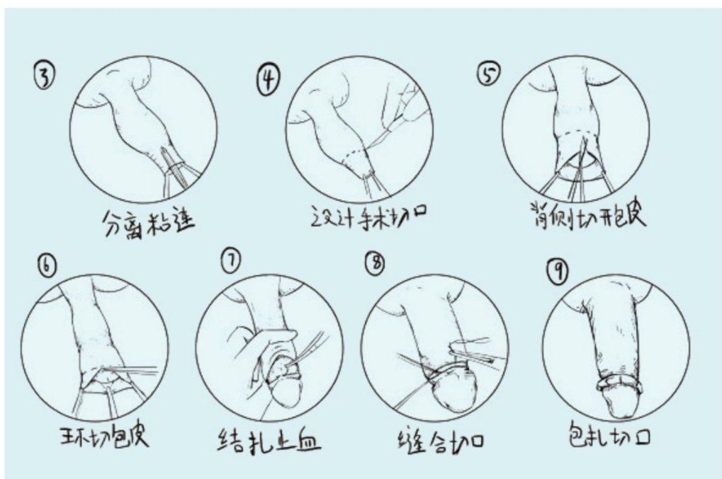 中山割包皮建议去哪个医院好?